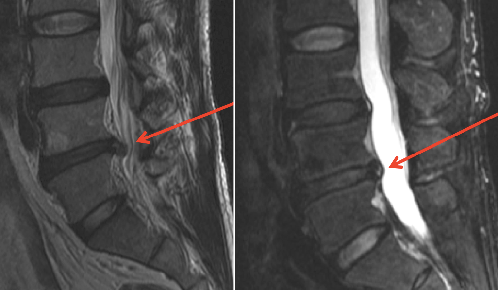 low-back-herniated-disk-before-and-after-prolotherapy-cure